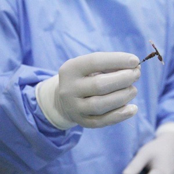 Vòng tránh thai biến sỏi trong bọng đái của người con gái