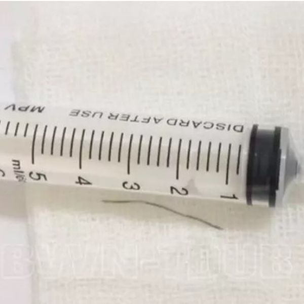 Dây thép dài sắp 4cm mắc vào cổ họng cụ bà 77 tuổi