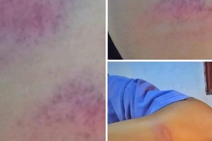Nghệ An: Cô giáo bị phụ huynh tố đánh nữ sinh lớp 7 thâm tím trên mạng 