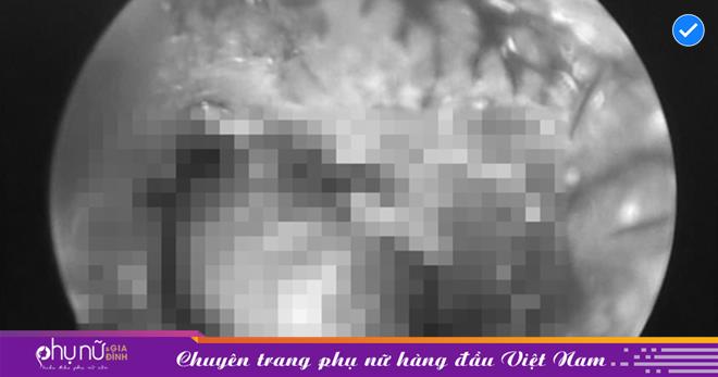 Ve chó sống trong tai gầy xíu gái 2 tuổi, bố mẹ nên tránh làm ngay lúc bắt gặp nhé!